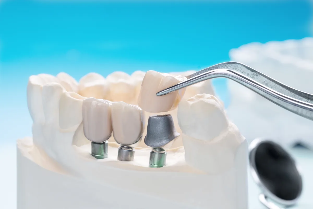 Dental Crowns & Bridges treatment in Merced, CA