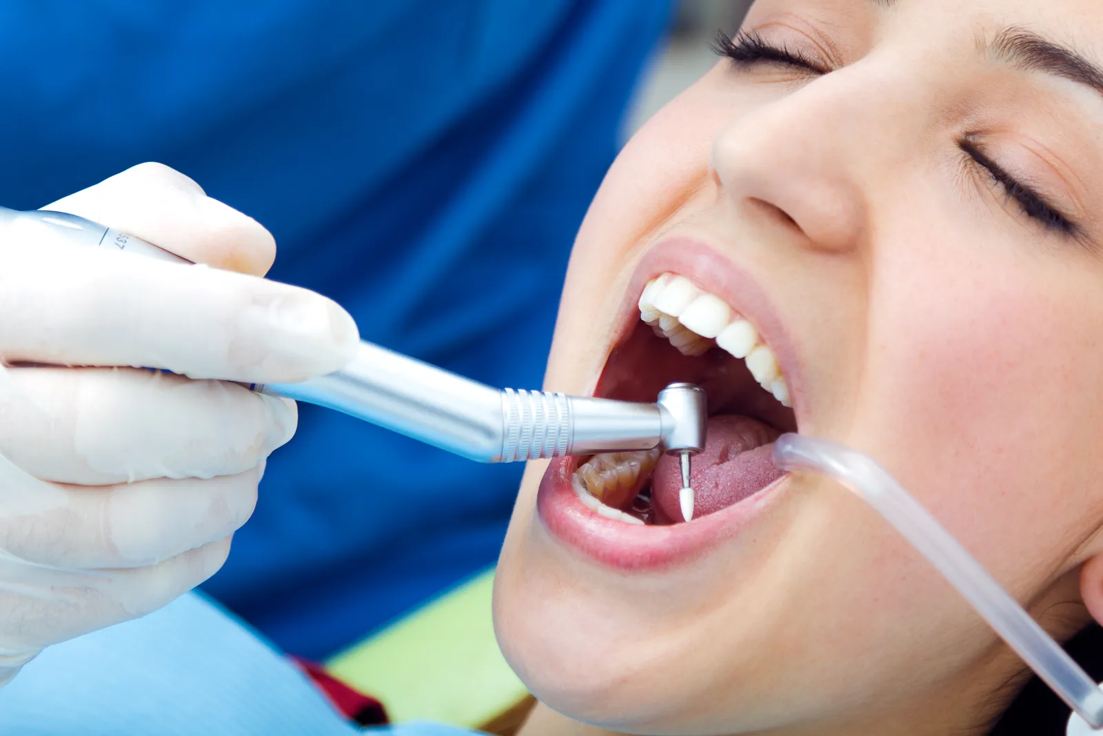Dental Filling at Shine Dental Group in Merced, CA