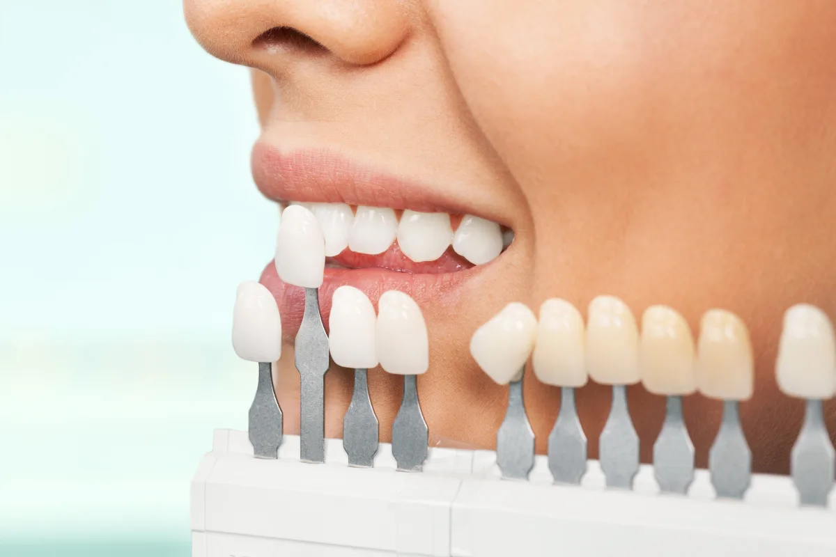 Porcelain Veneers treatment in Merced, CA