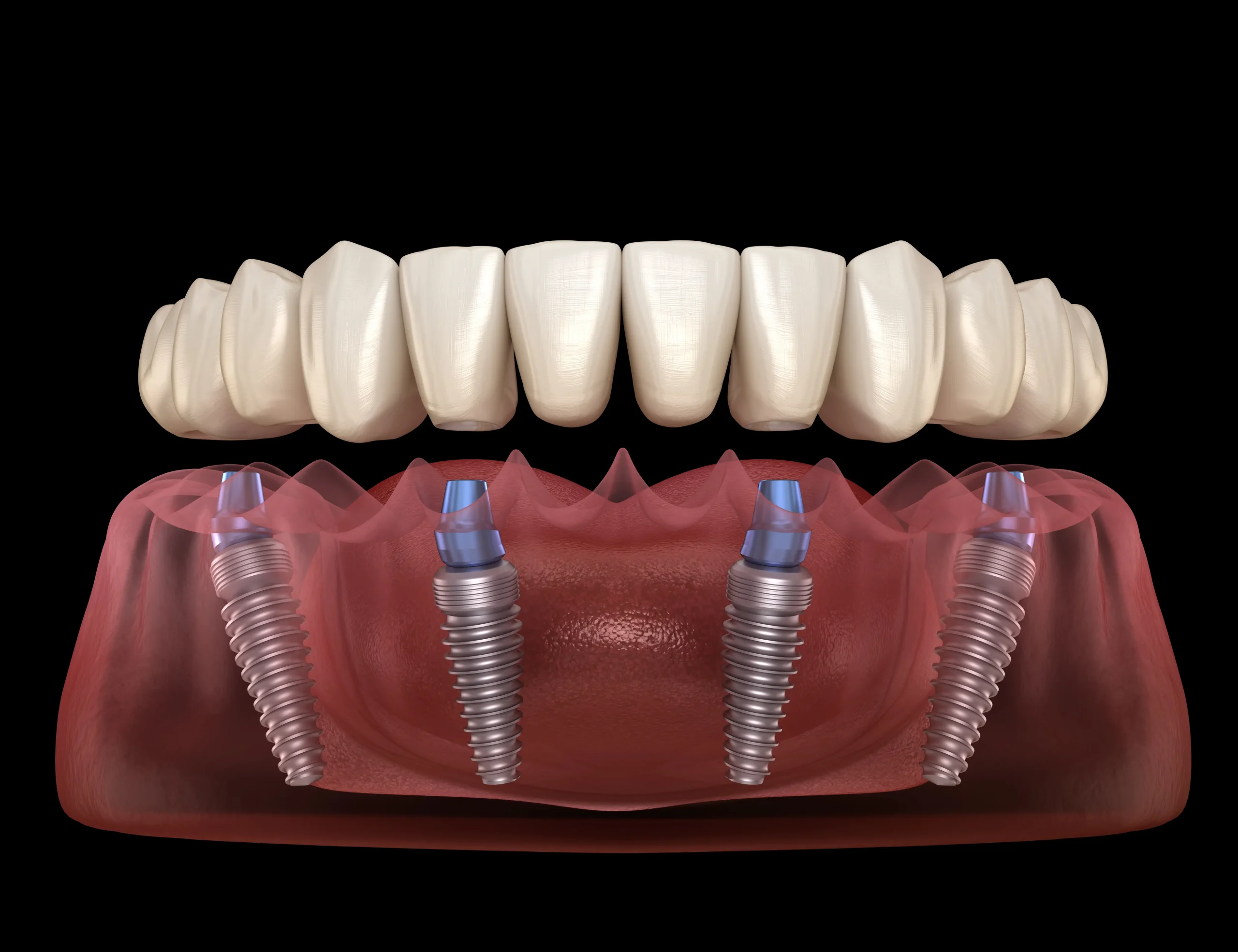 All-on-4 Dental Implants at Shine Dental Group in Merced, CA